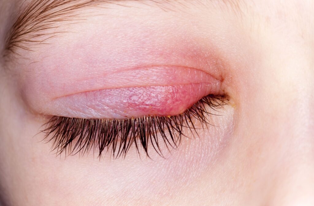 A close-up image of a patient's closed eye with a stye on the upper eyelid.