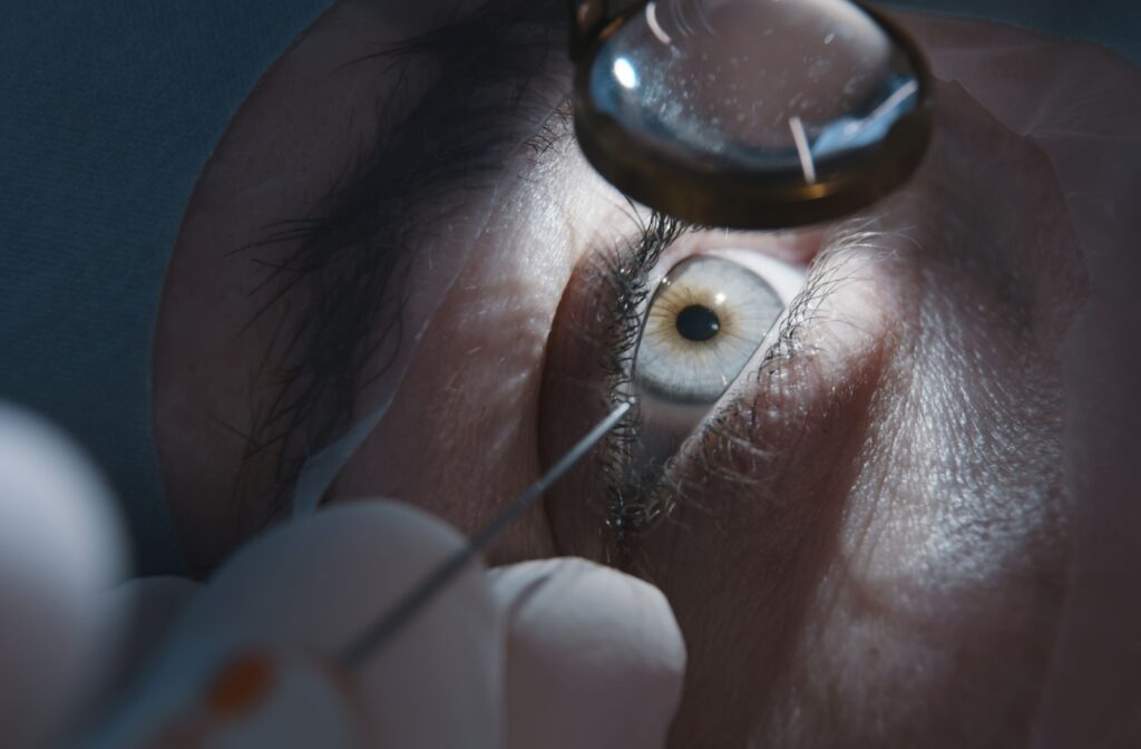 Close-up of a patient's eye as they're about to undergo laser eye surgery.