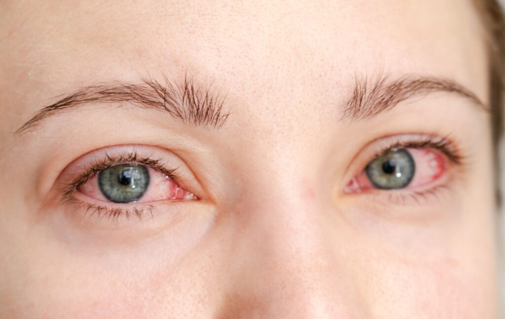 A person who has overused eye drops looks into the camera. Their eyes are red and irritated from rebound effects.